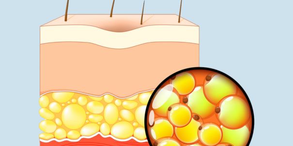 Ursachen: Warum entsteht ein Lipödem?